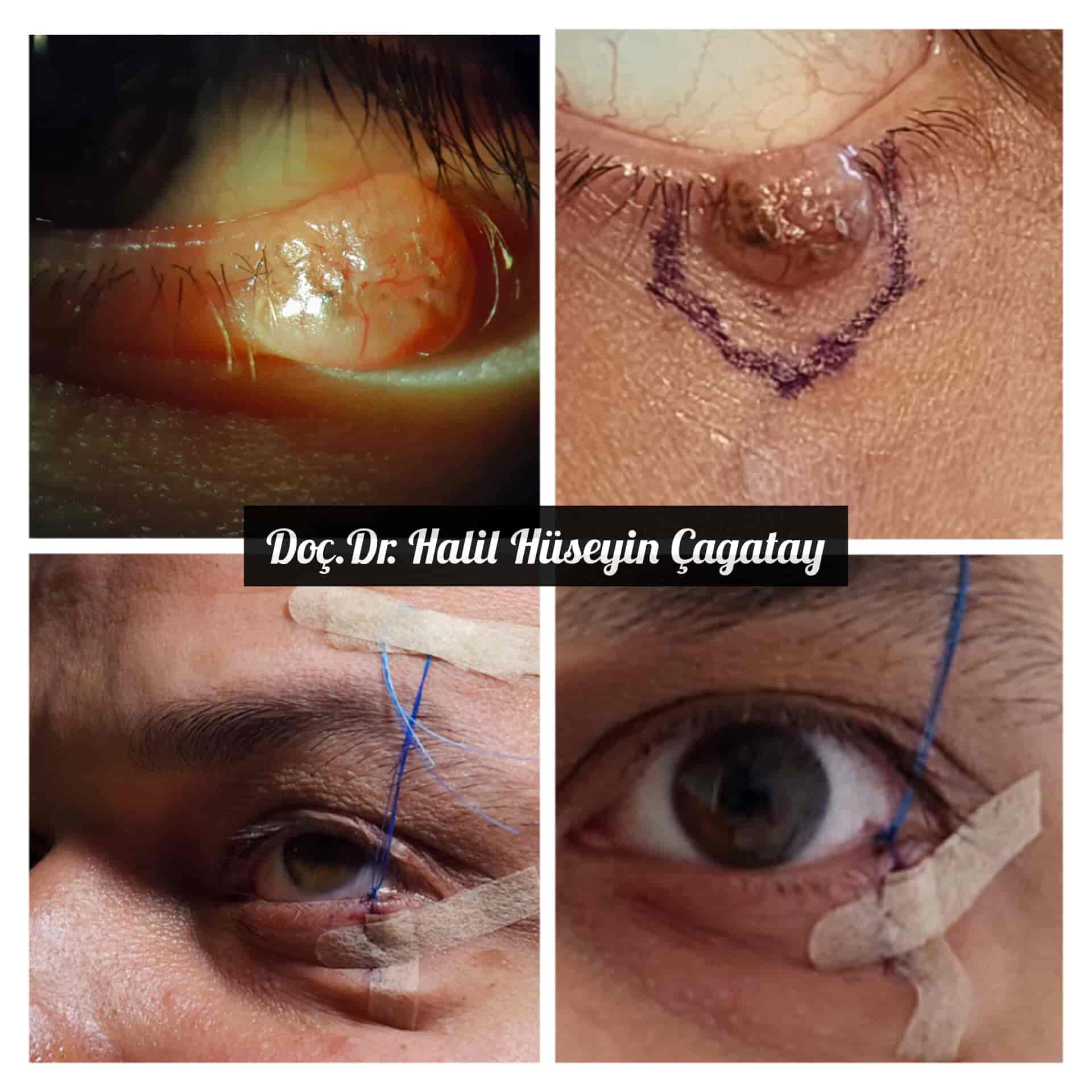 Göz Kapağında Kitle
