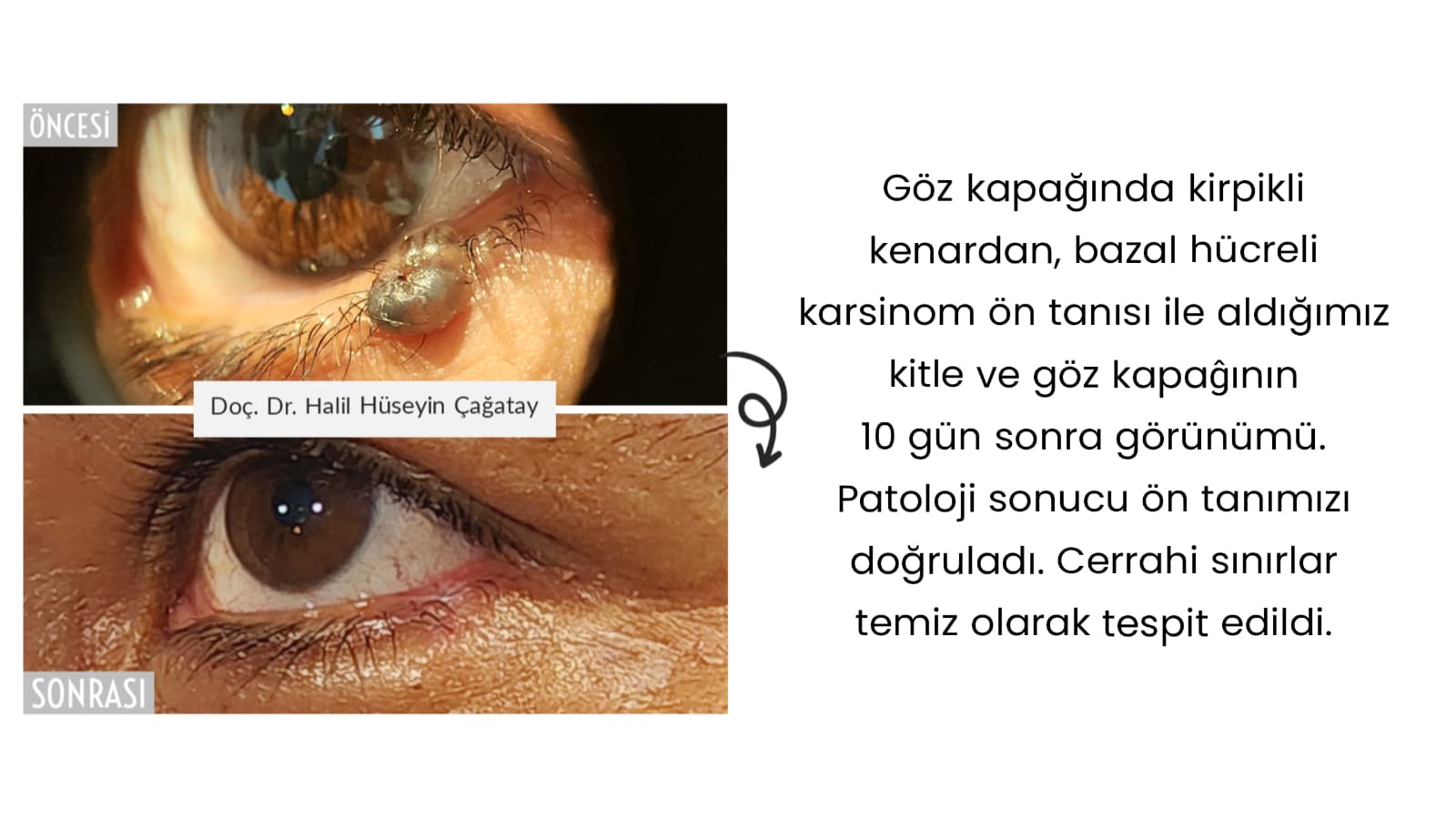 Göz Kapağında Kitle