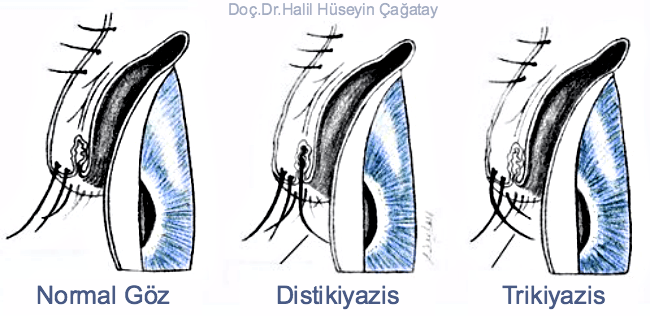 Distikiyazis
