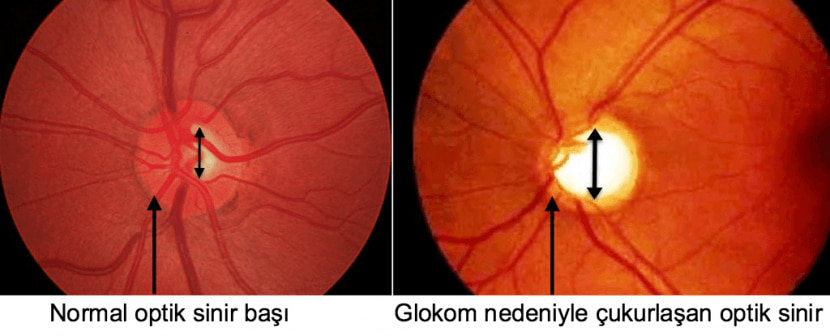 Glokom Tedavisi