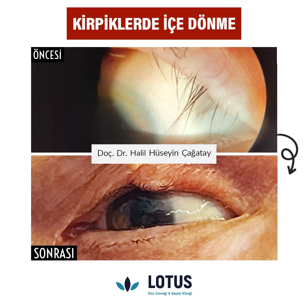 kirpiklerde içe dönme