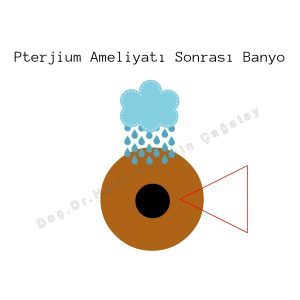 Pterjium Ameliyatı