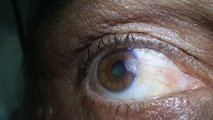 Pterjium Başlangıcı