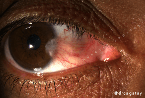 Pterjium