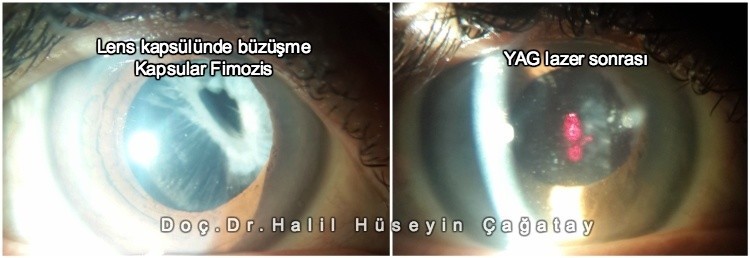 YAG Lazer Sonrası