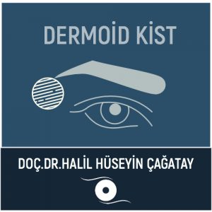 Dermoid Kist