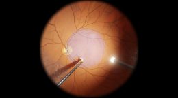 Epiretinal Membran