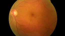 hipertansiyonlu retinopati)