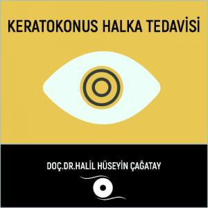 Keratokonus Halka Tedavisi