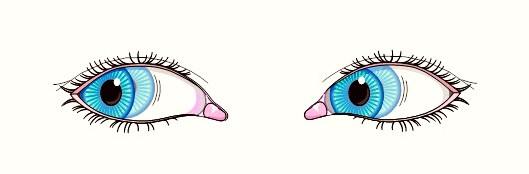 Nistagmus