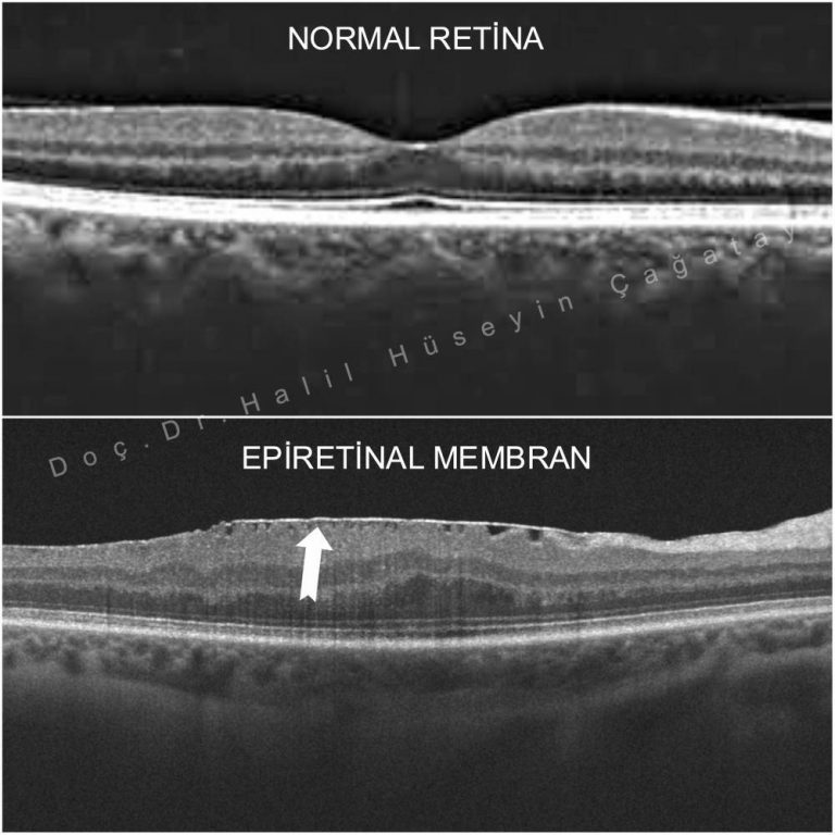 Epiretinal Membran