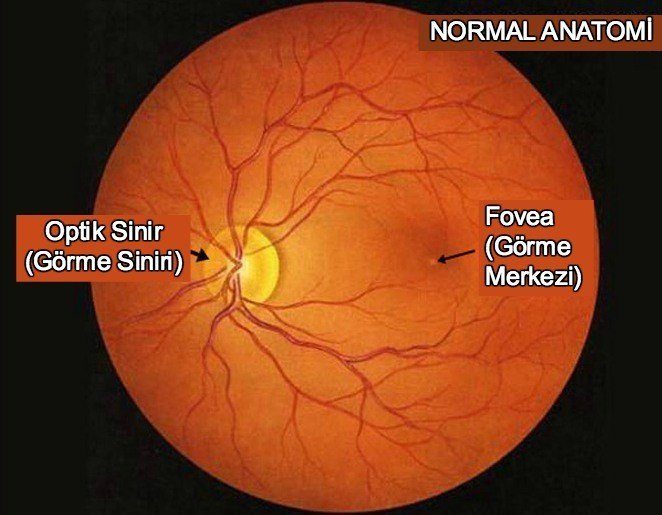 Hipertansif retinopati