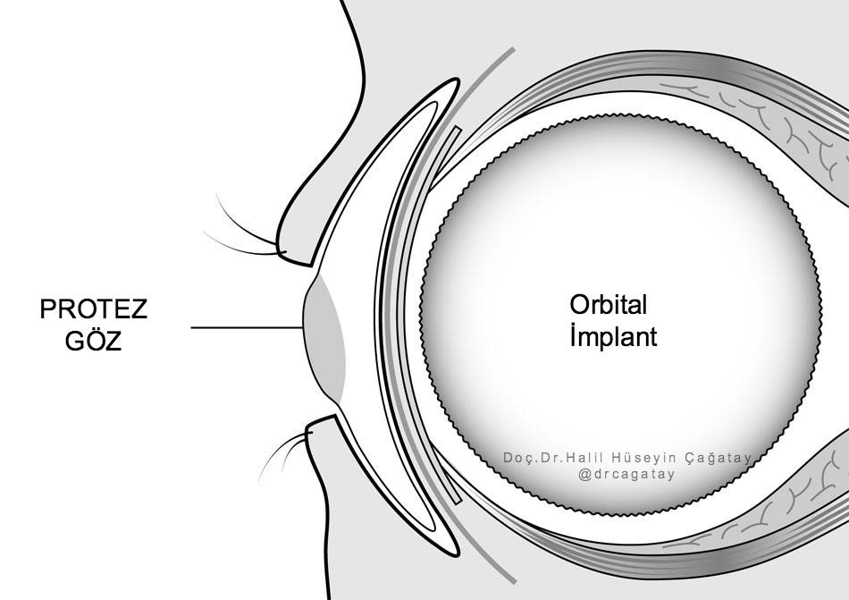 Orbital Implant