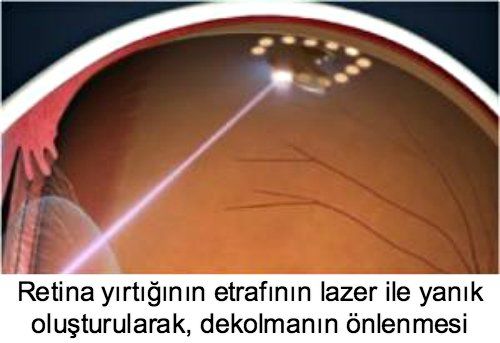 Retina Dekolmanı
