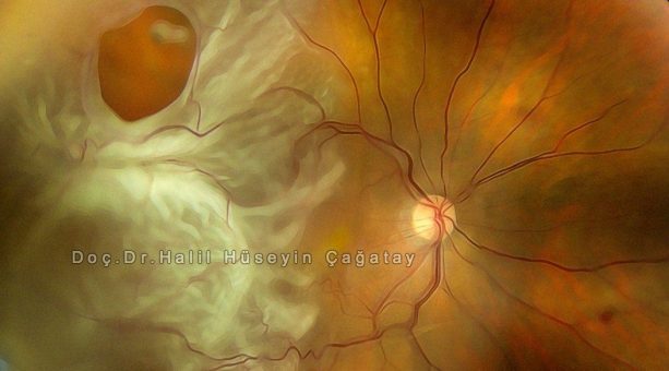 retina dekolmanı