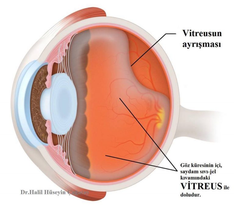 Retina Dekolmanı