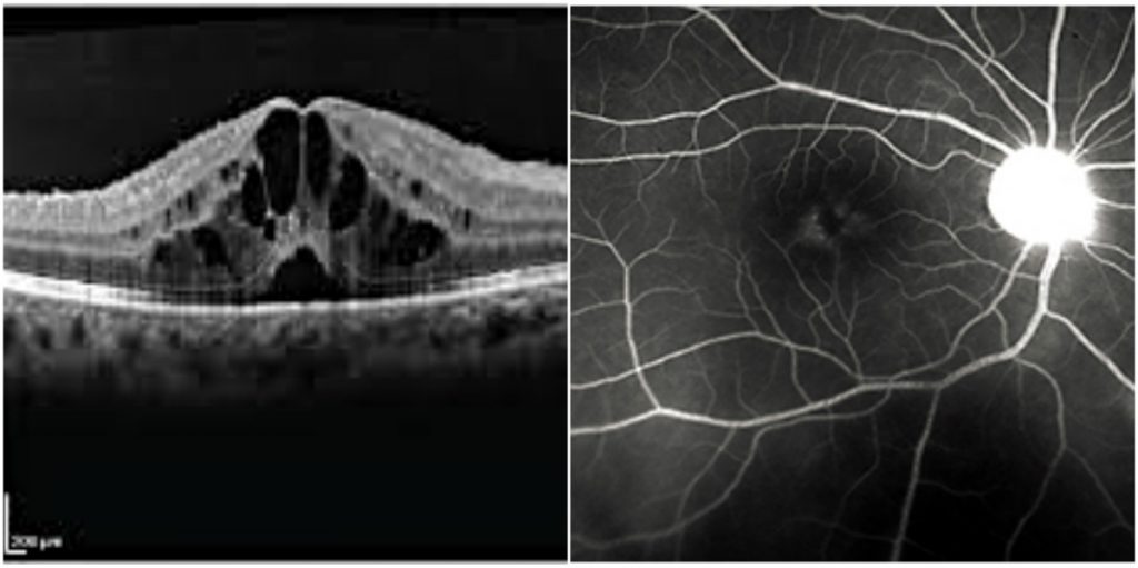 Retina