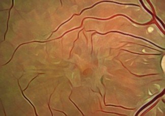 Retina Üzerinde Zar