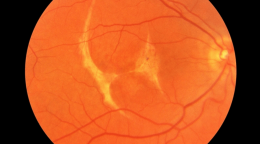 Retina Yırtılması ve Retina Dekolmanı