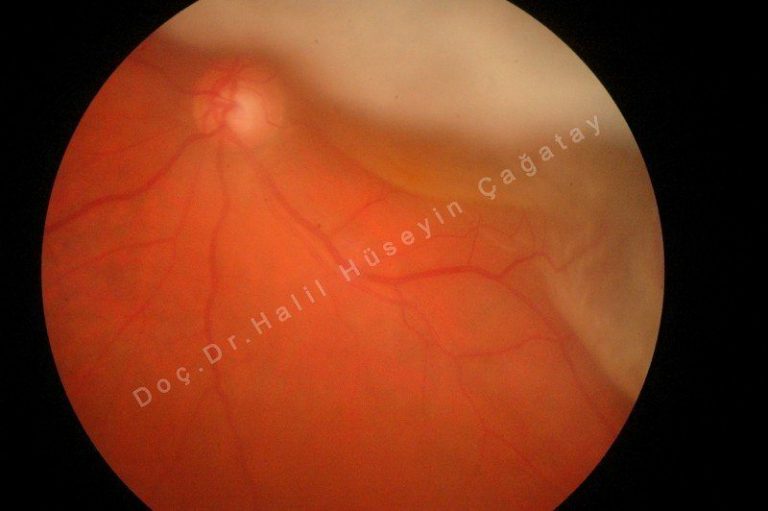Retina Dekolmanı