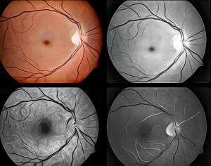 retina damar tıkanıklığı