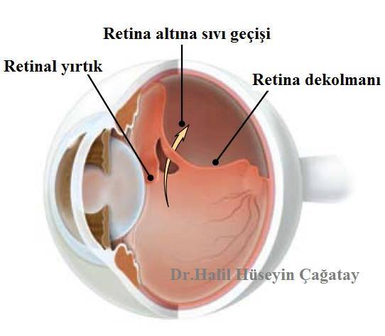 Retina Dekolmanı