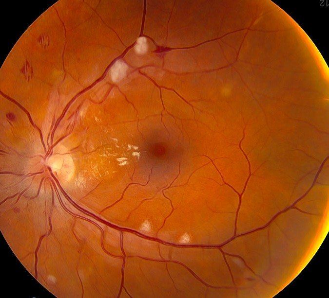 Hipertansif retinopati