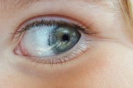 Nistagmus