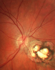 Toxoplazma Retiniti