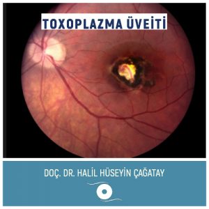 Toxoplazma Üveiti ve Toxoplazma Retiniti