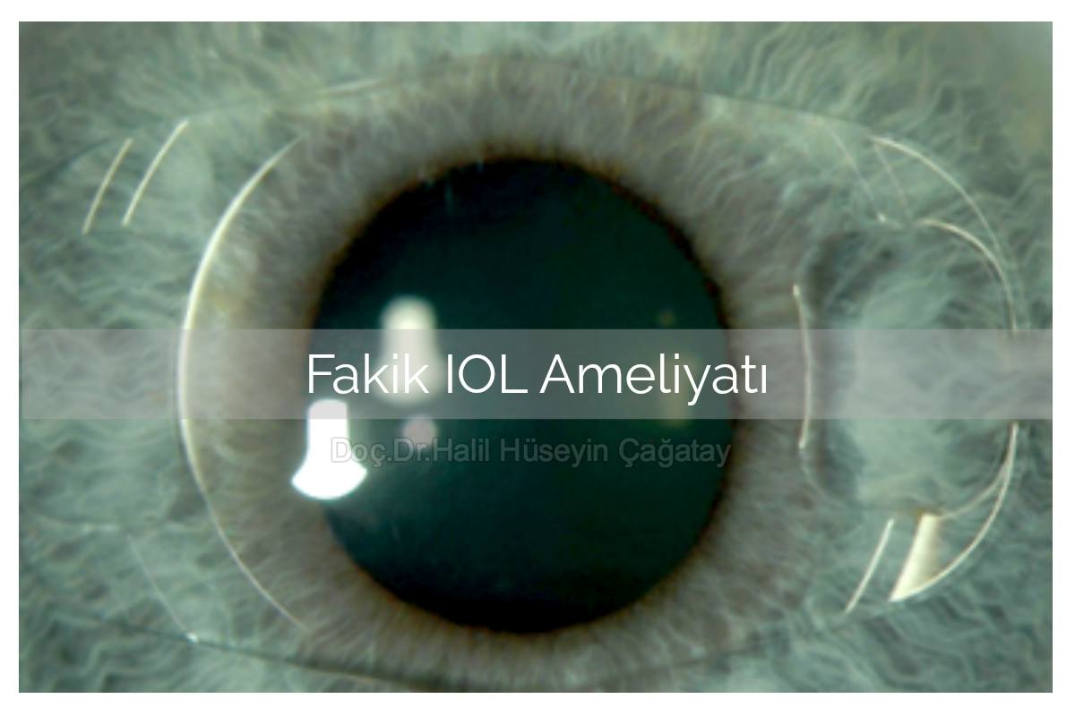 Fakik İOL Ameliyatı