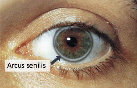 Arcus Senilis