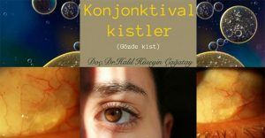 Konjonktival Kist