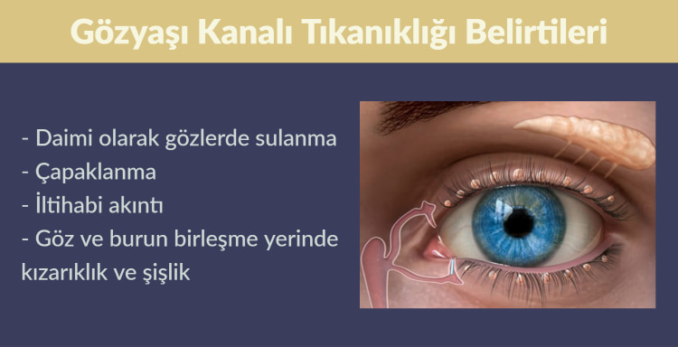 Gözyaşı Kanalı Tıkanıklığı Tedavisi