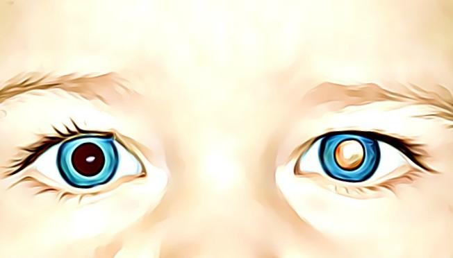 Retinoblastom Tedavisi