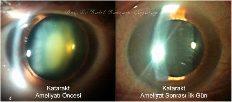 Katarakt Ameliyatı Öncesi Sonrası