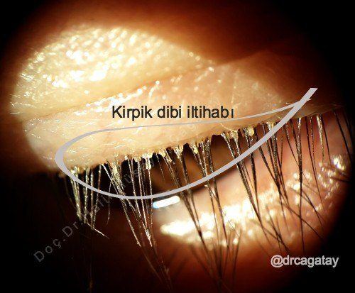 Kirpik Dibi İltihabı