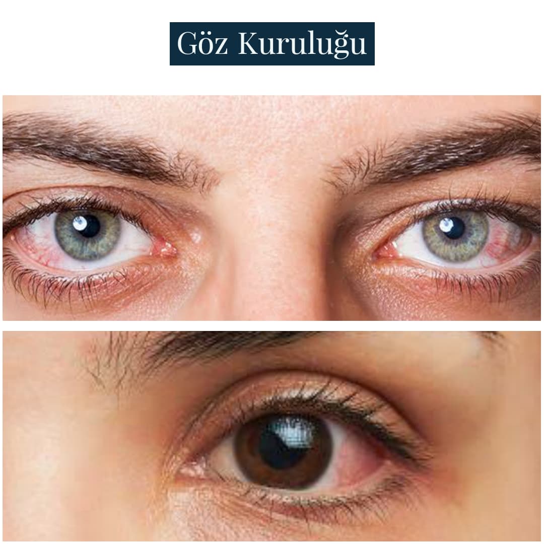Göz Kuruluğu