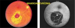 Retinal Arteriyel Makroanevrizma