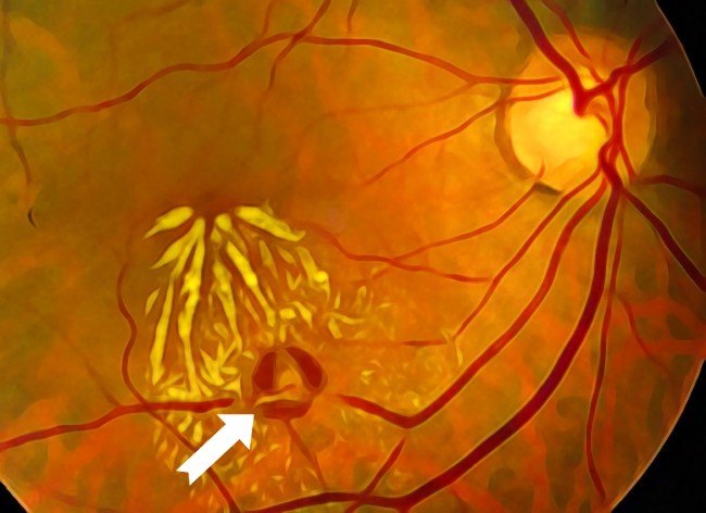 Retinal Arteriyel