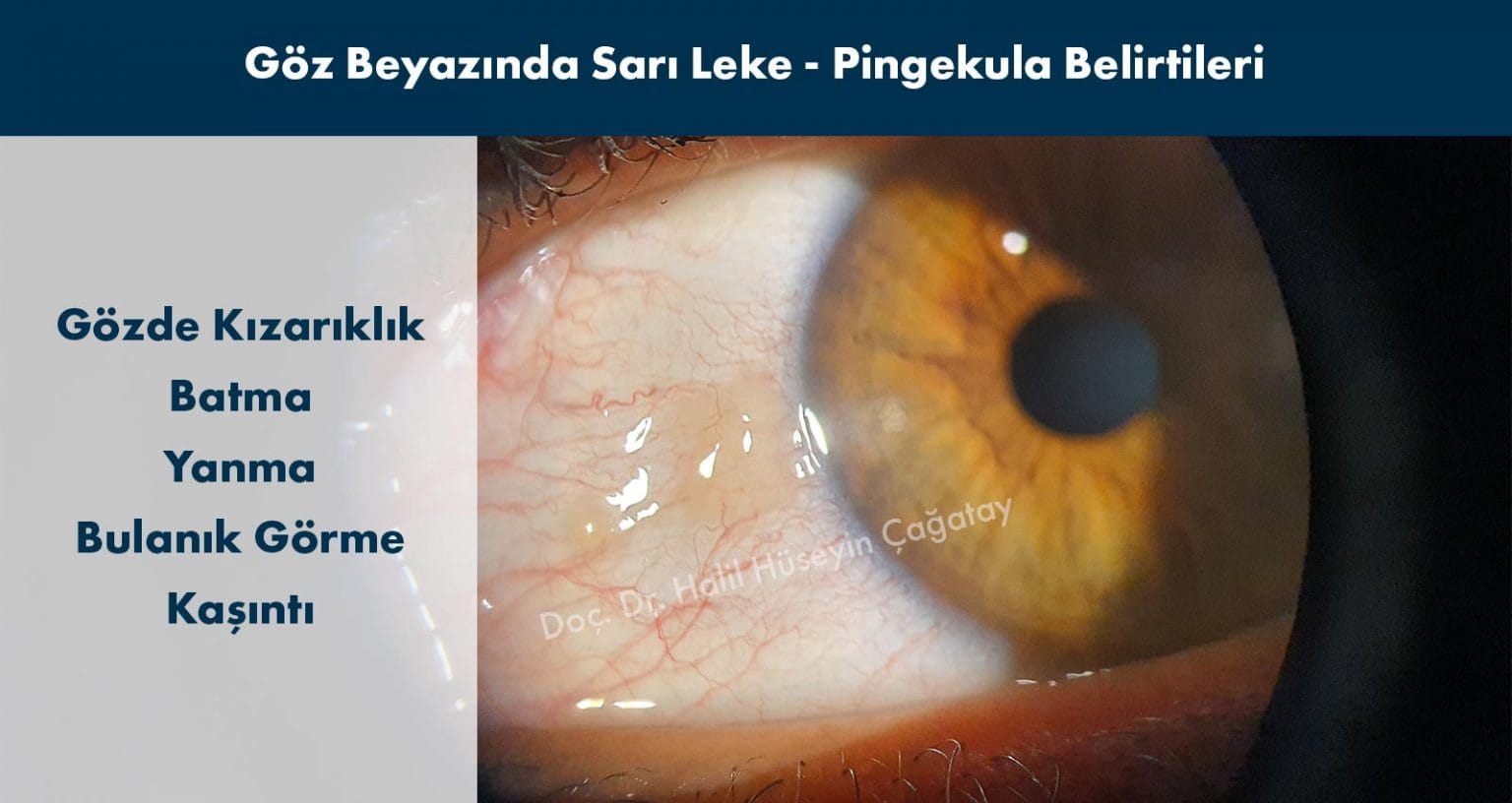 Göz Beyazında Sarı Leke