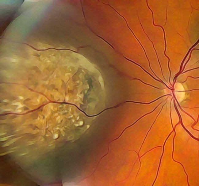 Koroidal Tümörler