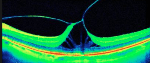Vitreomakular Traksiyon