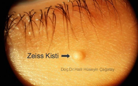 Zeiss Kisti