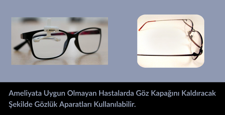 Kronik Progresif Eksternal Oftalmopleji